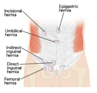 hernia